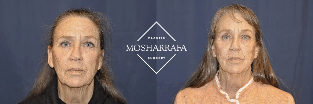 Before and after front and three-quarter views of patient following facial procedure at Mosharrafa Surgery