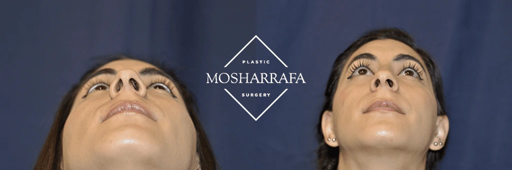 Before and after upward-looking view of female patient showing lower face changes