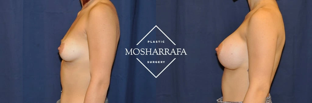 Before and after side profile view of breast augmentation results at Mosharrafa Surgery