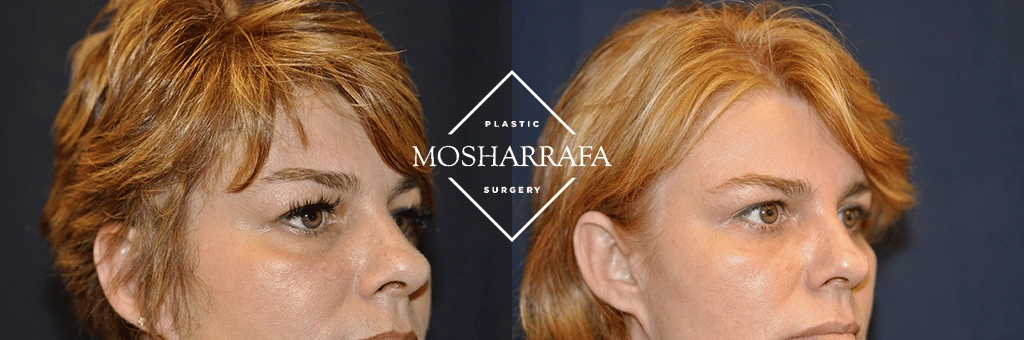 Before and after profile view showing facial contour changes from plastic surgery