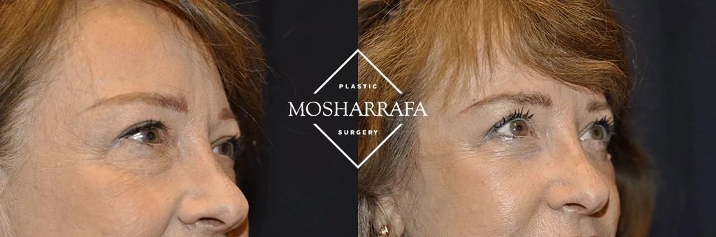 Before and after side profile showing refined facial contours and improved proportions