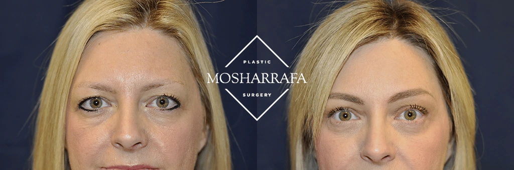 Before and after front-facing views showing facial definition changes