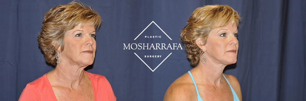 Before and after three-quarter view of woman's face showing facial rejuvenation results