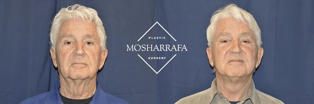 Before and after frontal view of man's face showing facial rejuvenation results