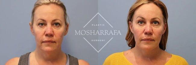 Before and after frontal views of facelift results showing lifted cheeks and refined facial structure