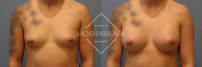 Before and after front-view comparison of breast augmentation results