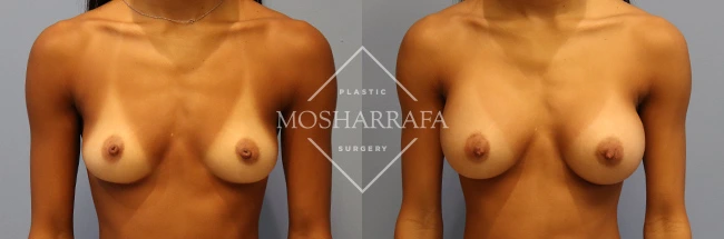Before and after front-view comparison of breast augmentation results