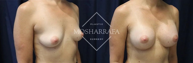 Before and after front view comparison of breast augmentation results