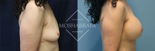 Breast augmentation before and after comparison, side view with different lighting