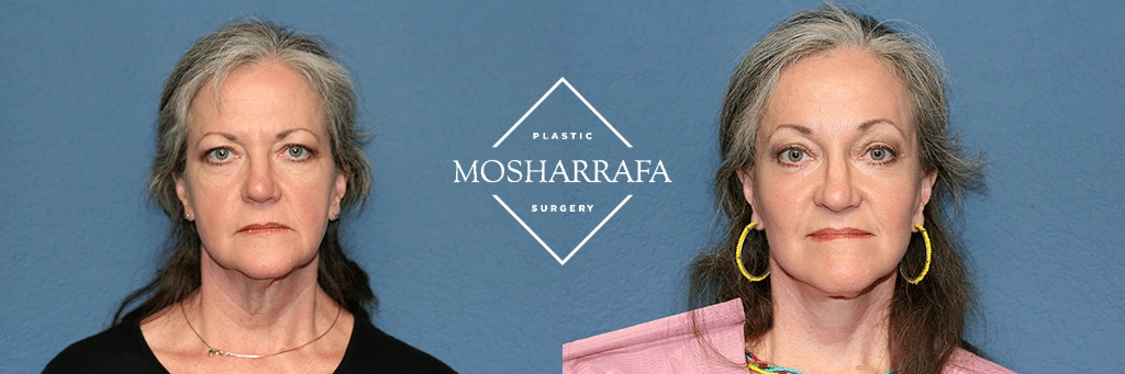 Before and after front-facing views of a woman's face wearing gold hoop earrings