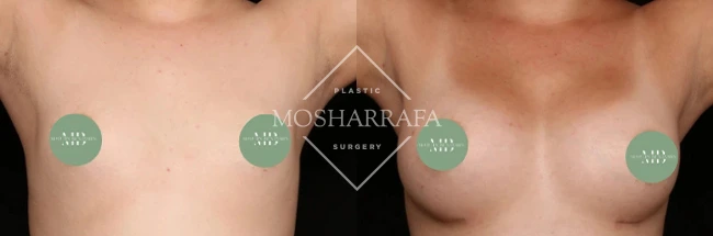 Before and after breast augmentation results, front view