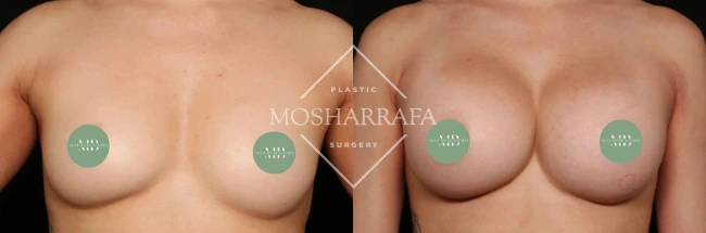 Before and after breast augmentation results, front view