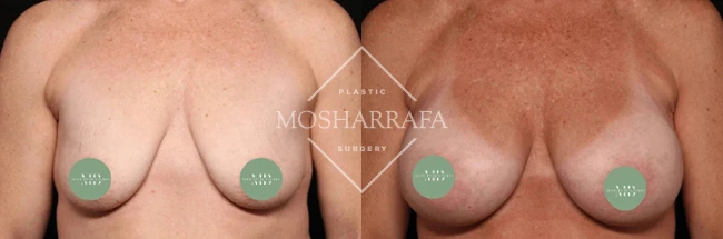 Before and after breast augmentation results, front view