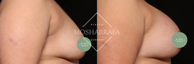 Before and after breast augmentation results, side view