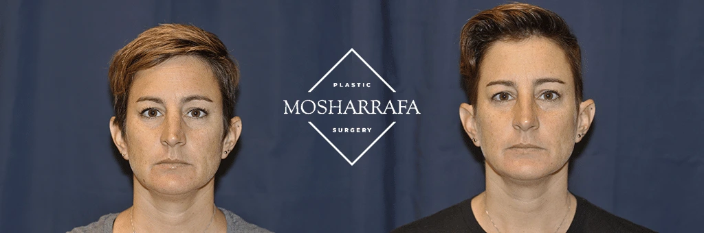 Before and after frontal facial photos showing results of cosmetic procedure