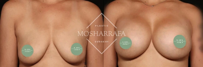 Before and after front view showing breast augmentation results