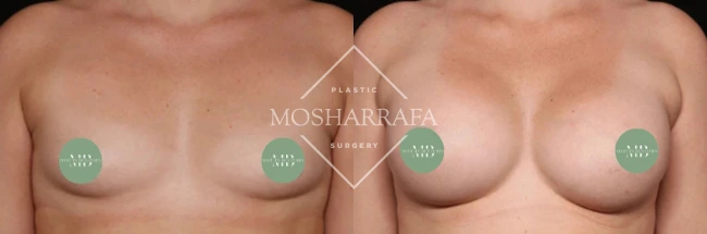 Front view of breast augmentation results with measurement markers