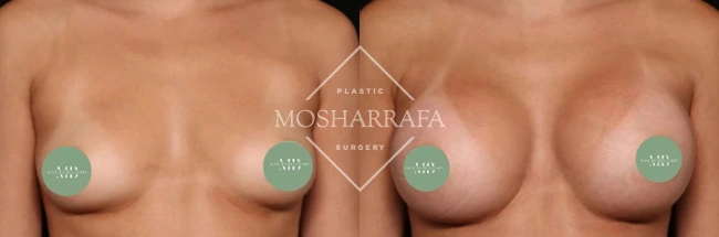 Before and after breast augmentation front view, case 328