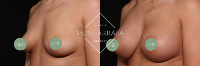 Before and after breast augmentation front view, case 329