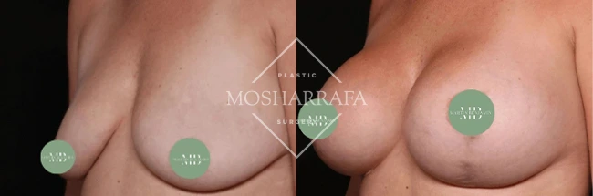 Before and after breast augmentation front view, case 330
