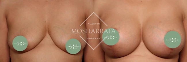 Before and after breast augmentation results showing frontal view