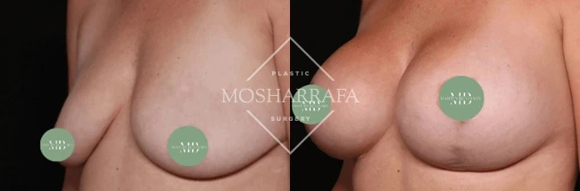 Before and after chest augmentation results with candidate markers