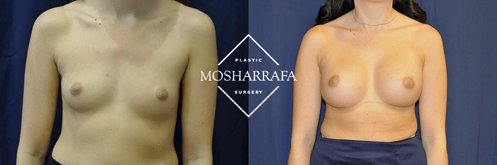 Breast augmentation before and after, front view comparison