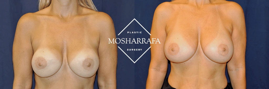 Before and after front views of breast augmentation results from Plastic Mosharrafa Surgery