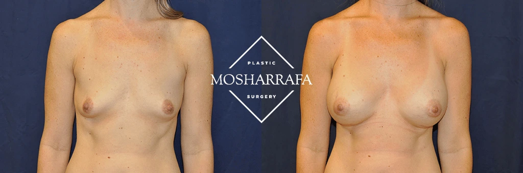 Before and after frontal view of breast augmentation results