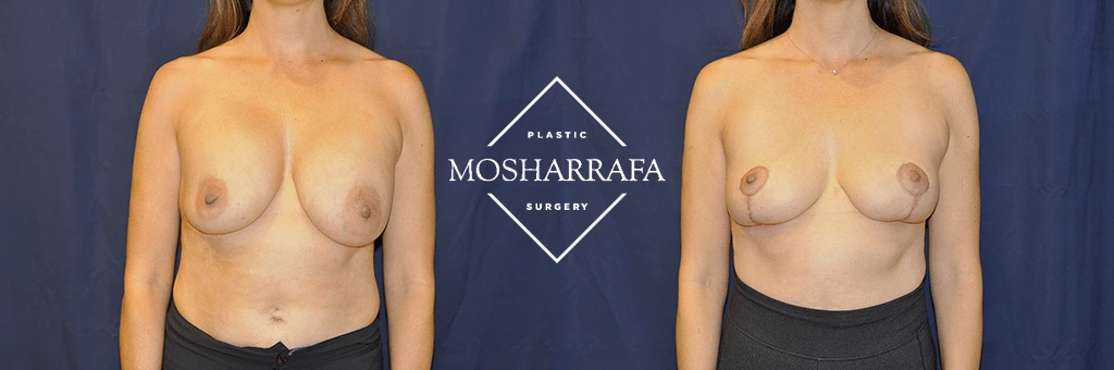 Before and after frontal breast augmentation surgery case 64