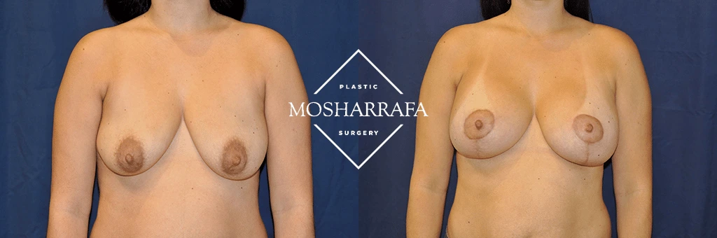 Before and after breast augmentation results, front view