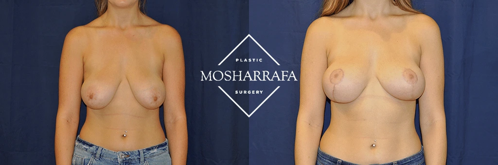 Before and after breast surgery comparison, front view