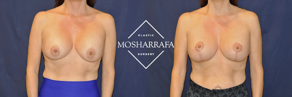 Before and after front view comparison of breast augmentation results