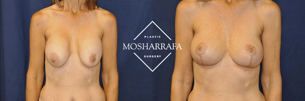 Before and after front view of breast augmentation results