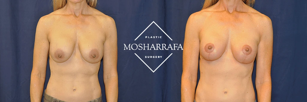 Before and after frontal view comparison of breast augmentation surgery results