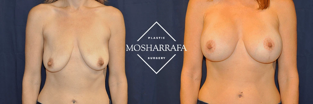 Before and after breast augmentation surgery, front view comparison