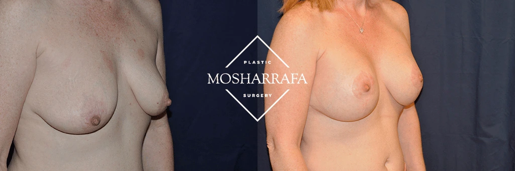 Before and after breast augmentation surgery, side angle comparison