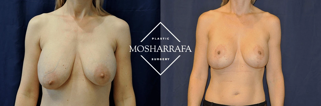 Before and after breast surgery results shown front view