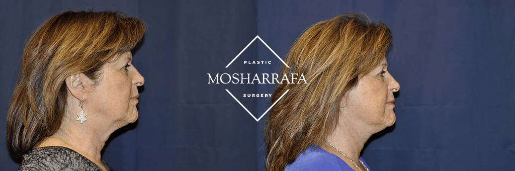 Woman's profile before-and-after facial appearance comparison