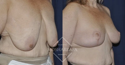 Before and after breast lift, side view