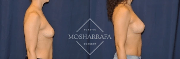 Before and after breast augmentation surgery, side view