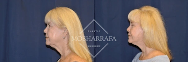 Woman's profile before-and-after facial appearance comparison