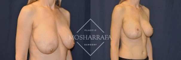 Breast augmentation before and after, angled front view comparison