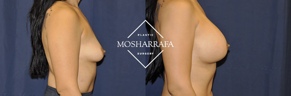 Breast augmentation before and after, side profile comparison