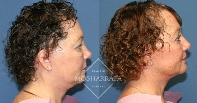 Before and after profile views showing facial contour and skin quality changes