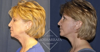 Before and after profile views showing facial rejuvenation and contour definition changes