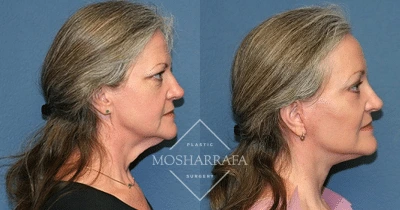 Before and after side profile views of a patient showing jawline and neck definition