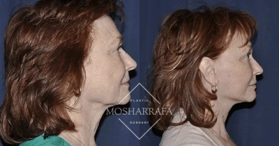 Before and after profile view of female patient showing facial contouring results