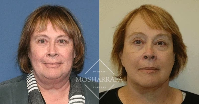Before and after frontal view of female patient showing facial aesthetic improvement
