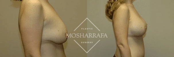 Before and after side view of breast augmentation results